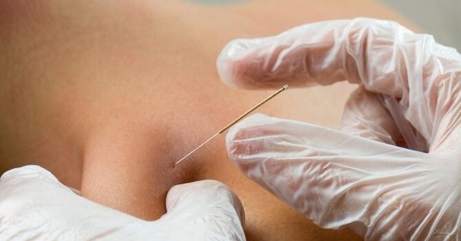 How Dry Needling Helps Athletes Recover from Sports Injuries